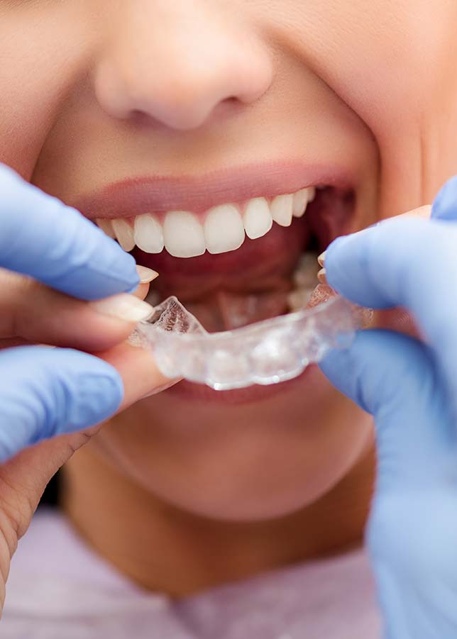 Etapes traitement orthodontie