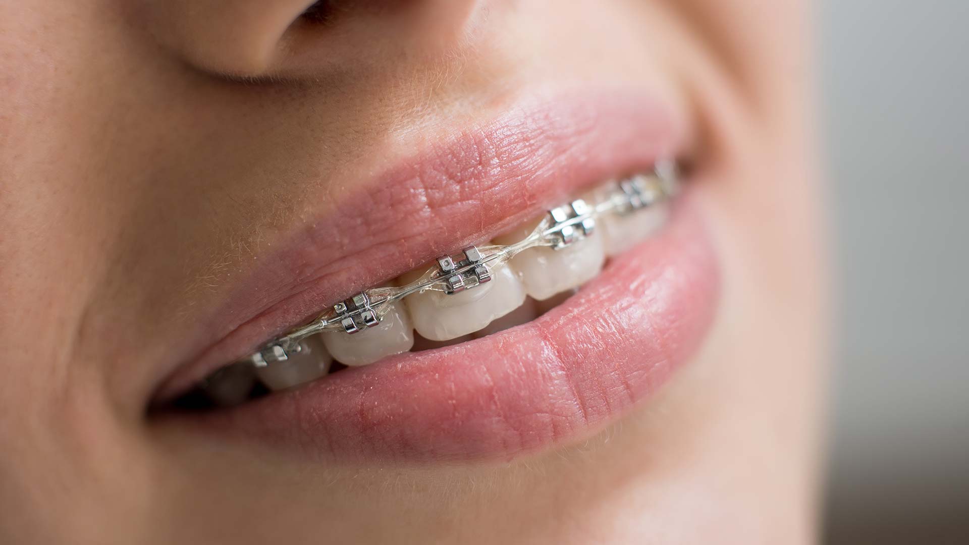L’orthodontie de l’adulte : un effet de mode ?
