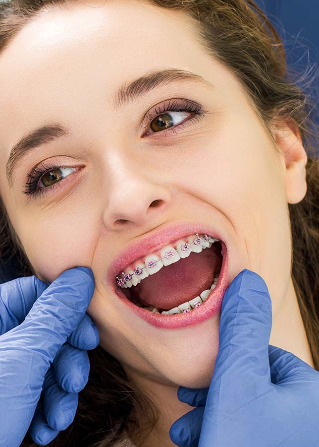 Etapes traitement orthodontie